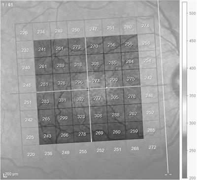 Morphological and Functional Inner and Outer Retinal Layer Abnormalities in Eyes with Permanent Temporal Hemianopia from Chiasmal Compression